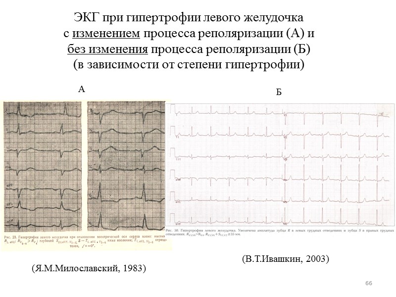 66 ЭКГ при гипертрофии левого желудочка с изменением процесса реполяризации (А) и 66 ЭКГ при гипертрофии левого желудочка с изменением процесса реполяризации (А) и